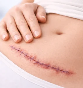 Caesarean section scars​