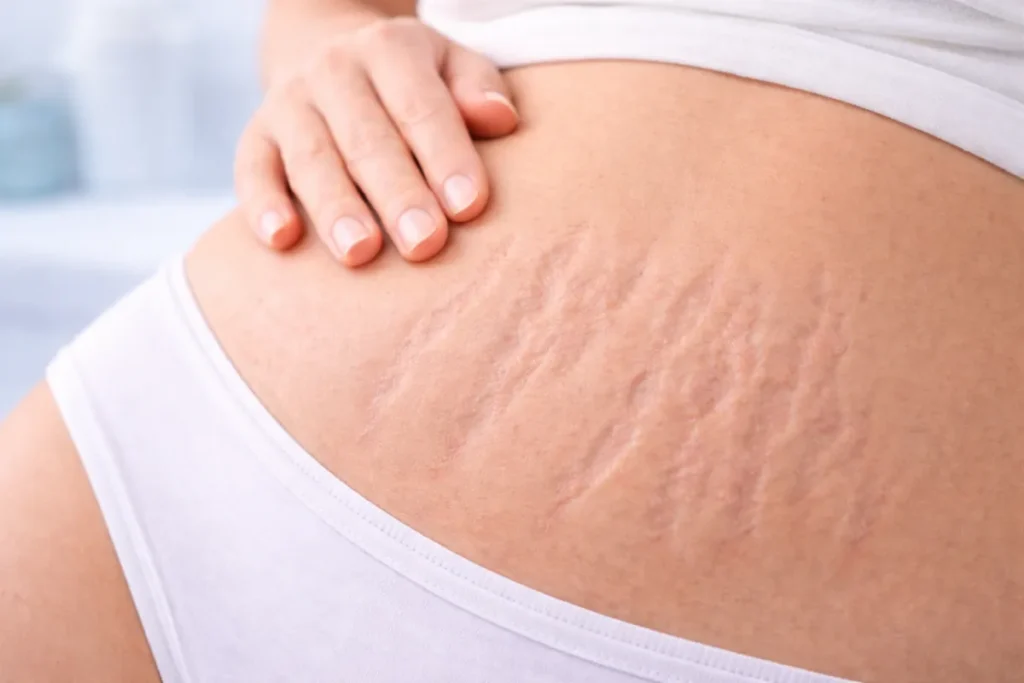 Stretch marks​